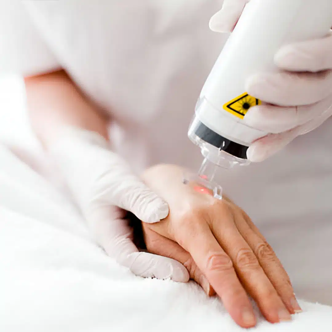 co2 laser resurfacing 1