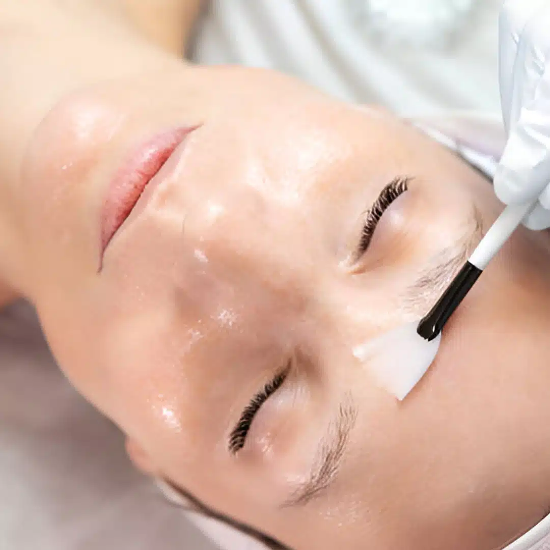 chemical peels 1