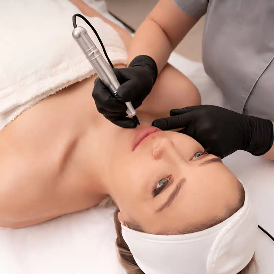 microneedling3